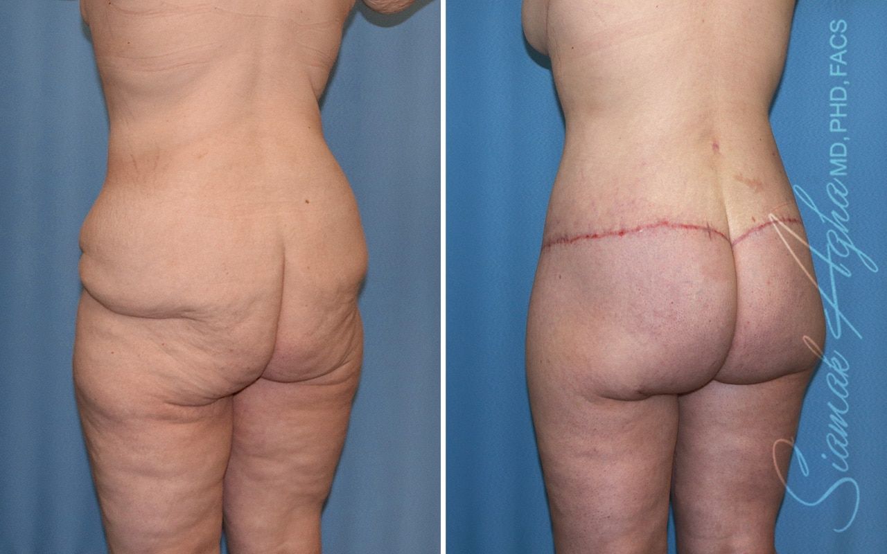 Lower Body Lift Before & After