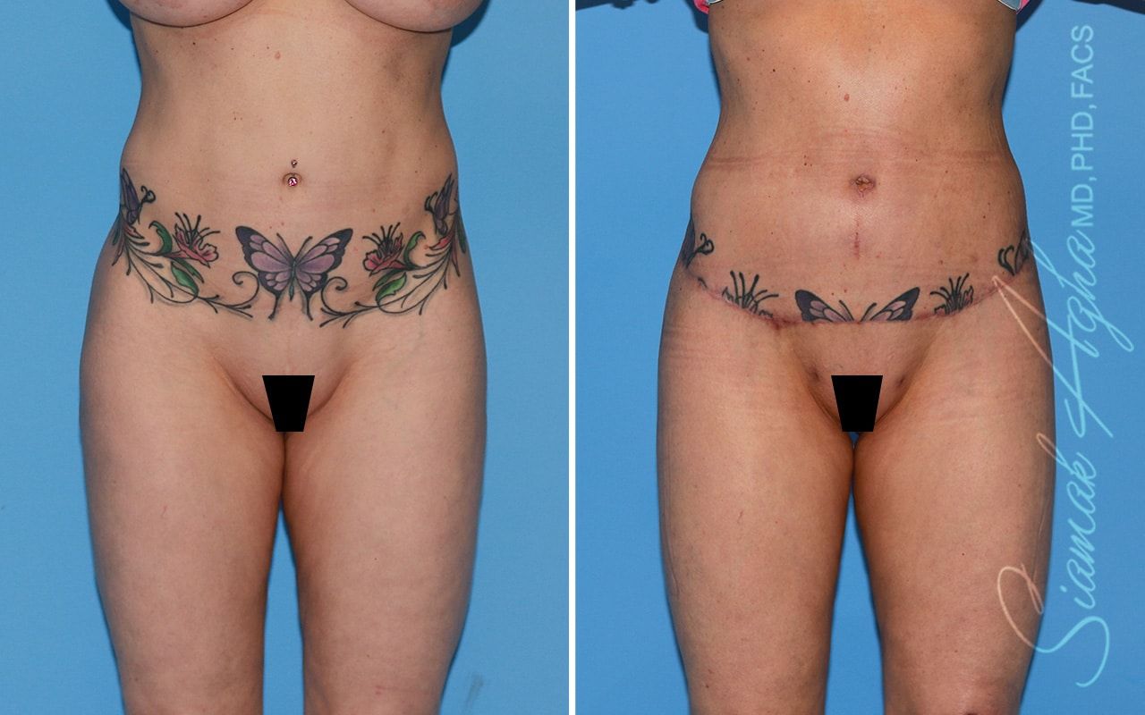 Lower Body Lift Before & After