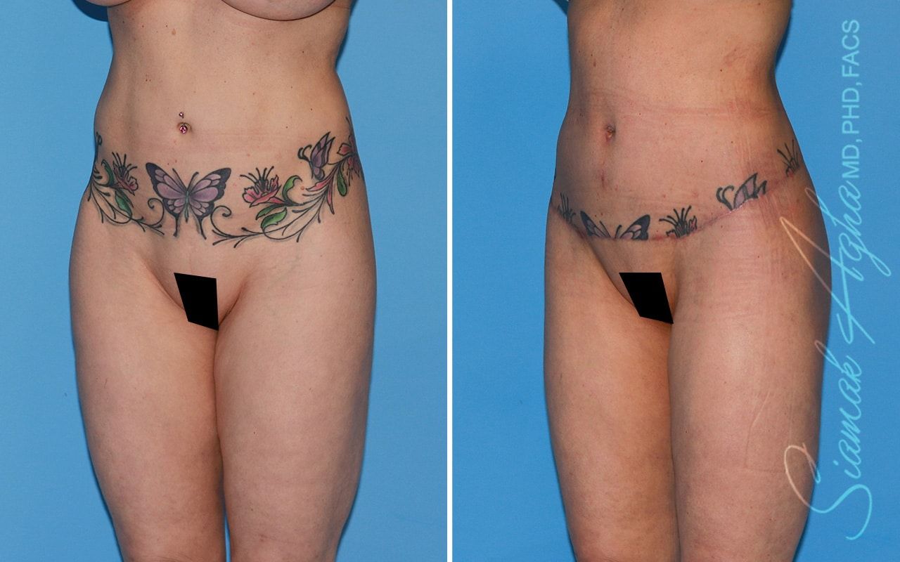 Lower Body Lift Before & After