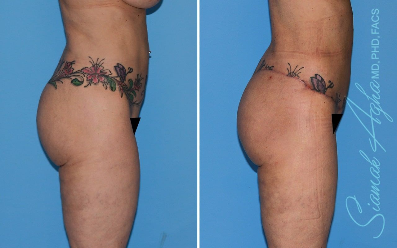 Lower Body Lift Before & After