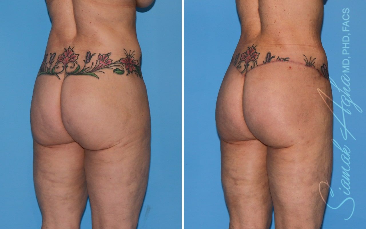 Lower Body Lift Before & After