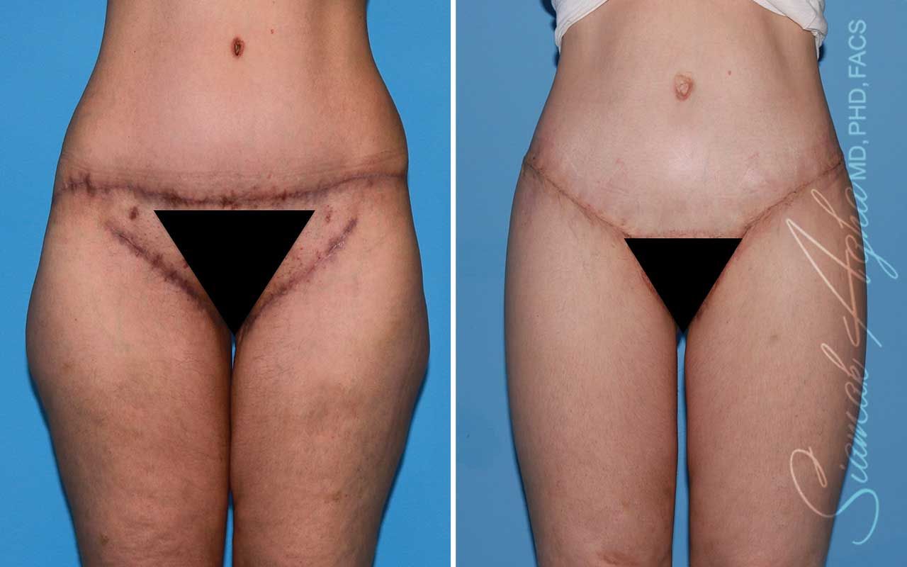 Lower Body Lift Before & After