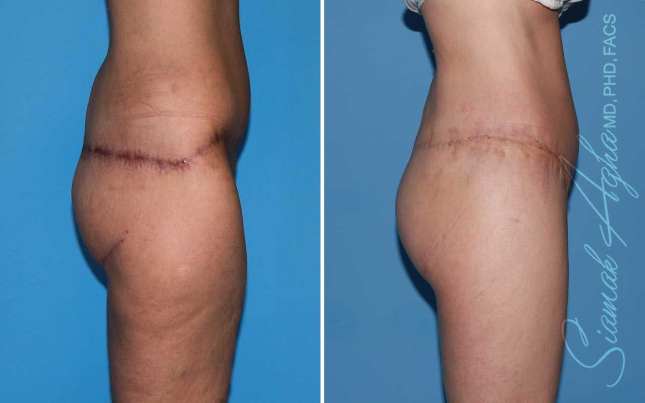 Lower Body Lift Before & After