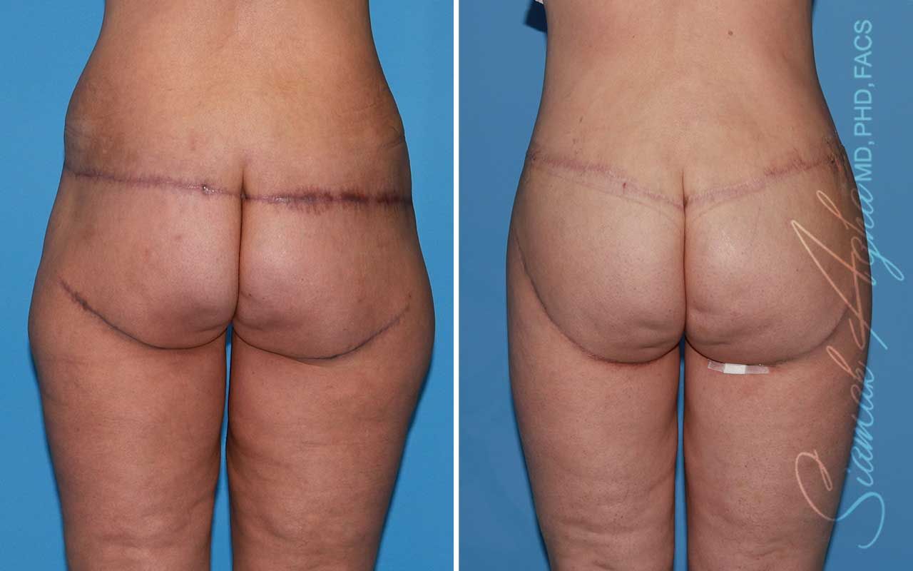 Lower Body Lift Before & After
