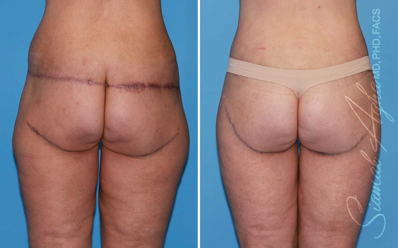 Lower Body Lift Before & After