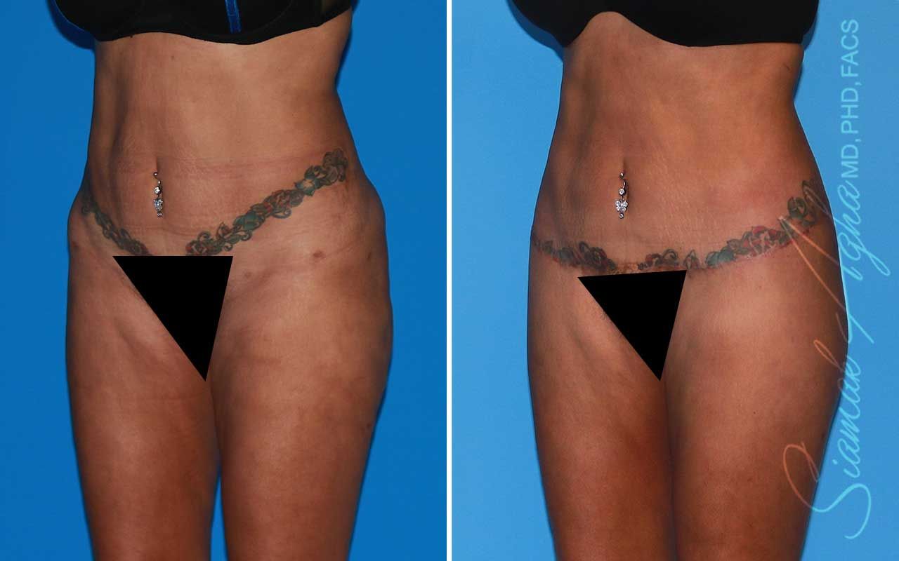 Lower Body Lift Before & After