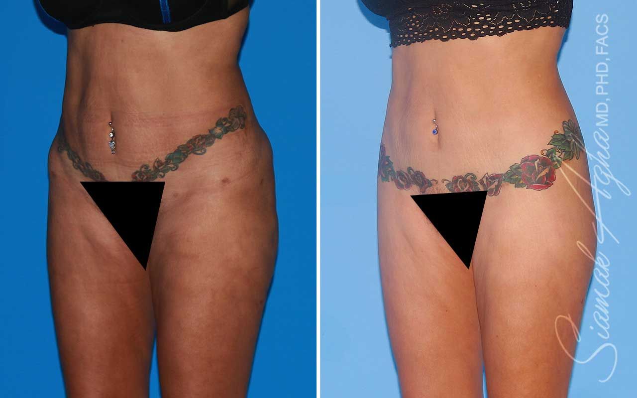 Lower Body Lift Before & After