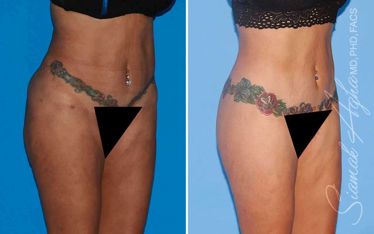 Lower Body Lift Before & After