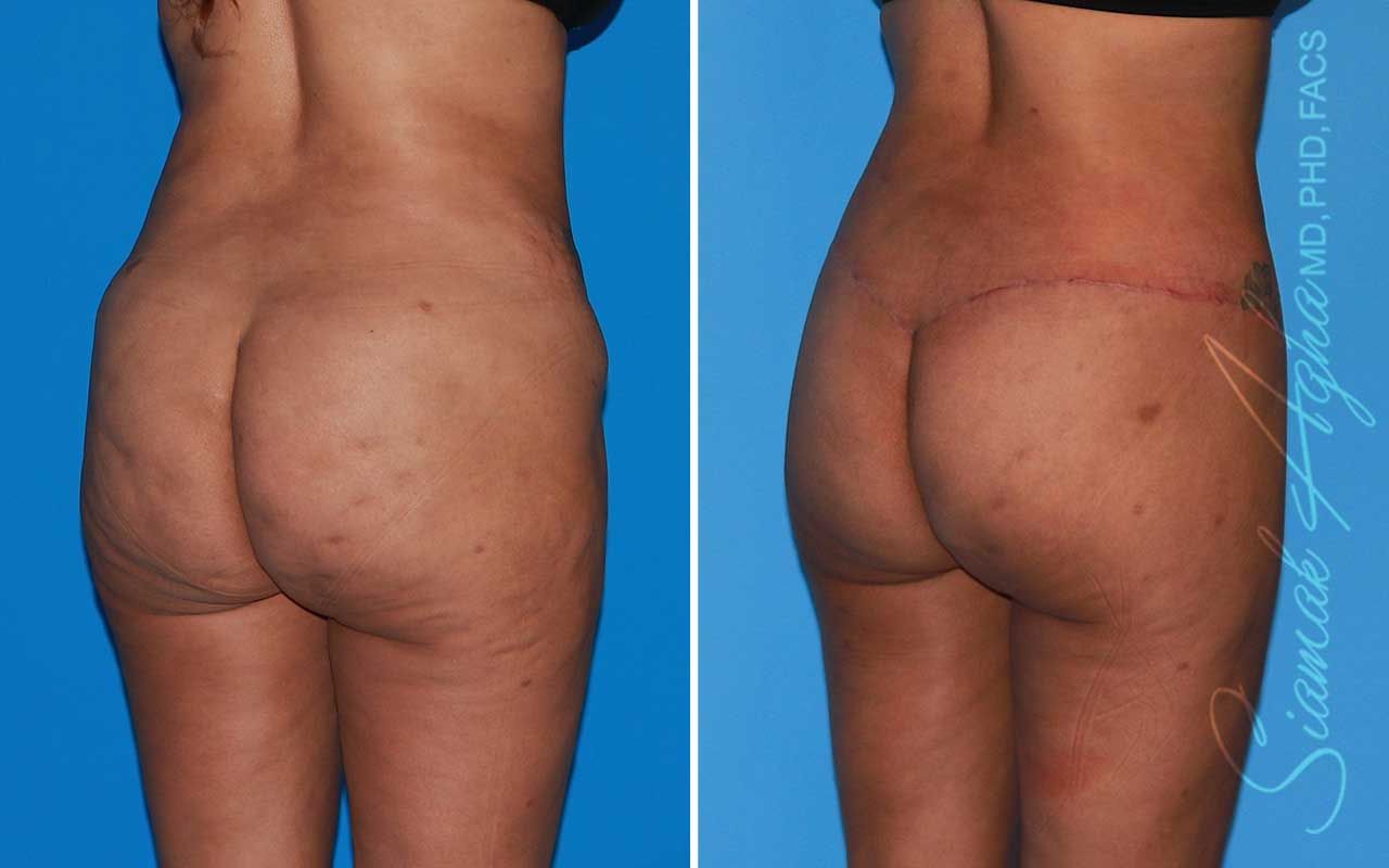 Lower Body Lift Before & After