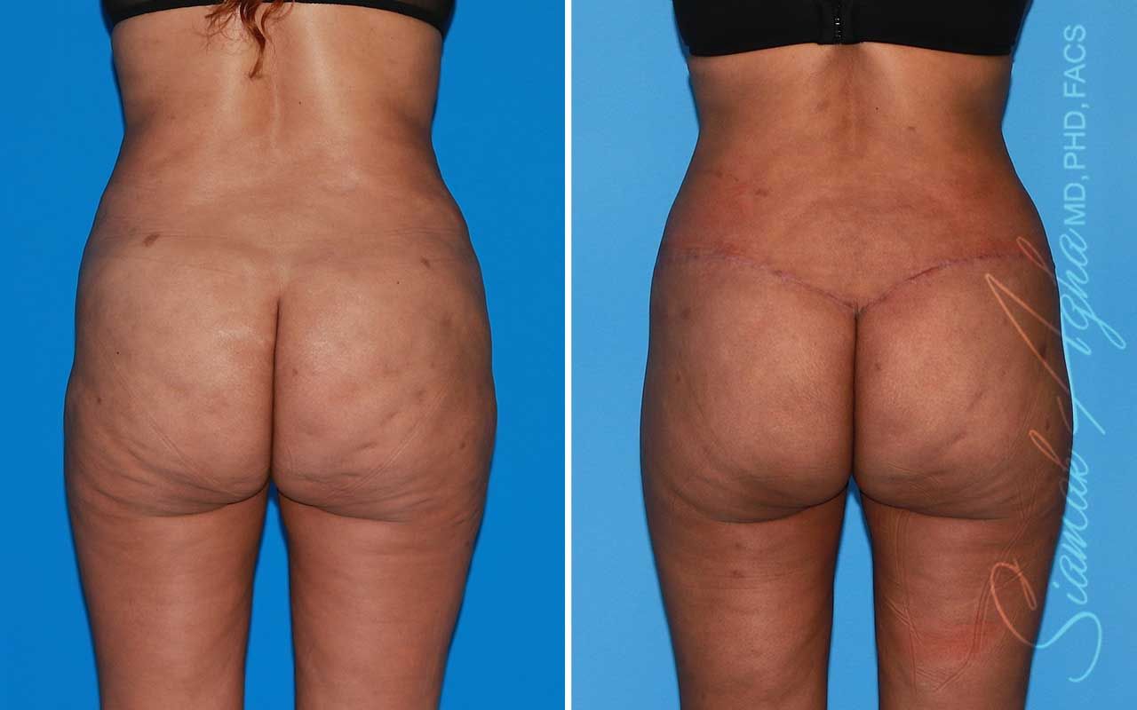 Lower Body Lift Before & After