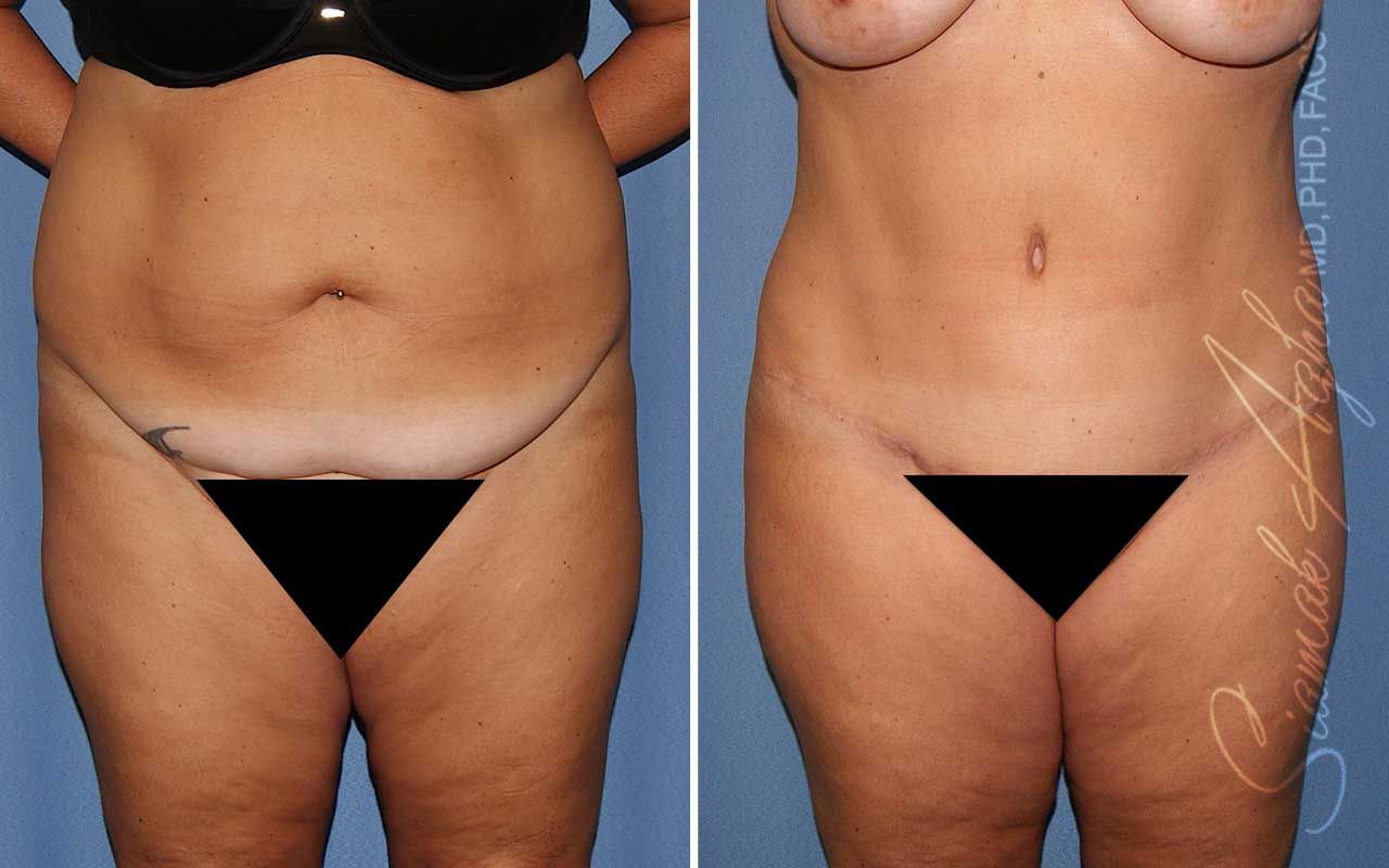 Lower Body Lift Before & After