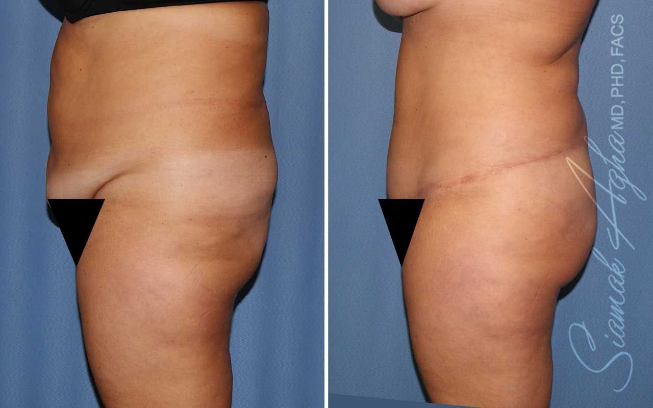 Lower Body Lift Before & After