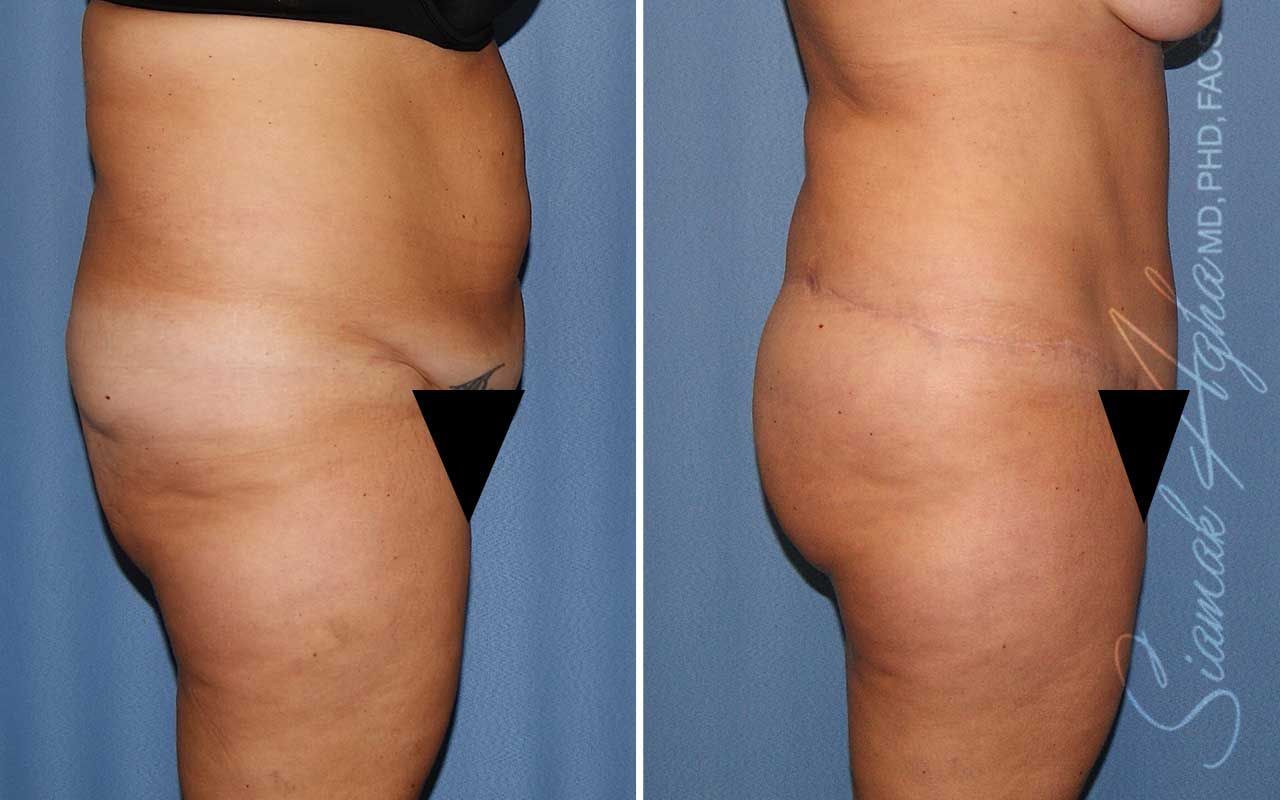 Lower Body Lift Before & After