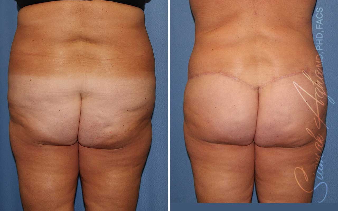 Lower Body Lift Before & After