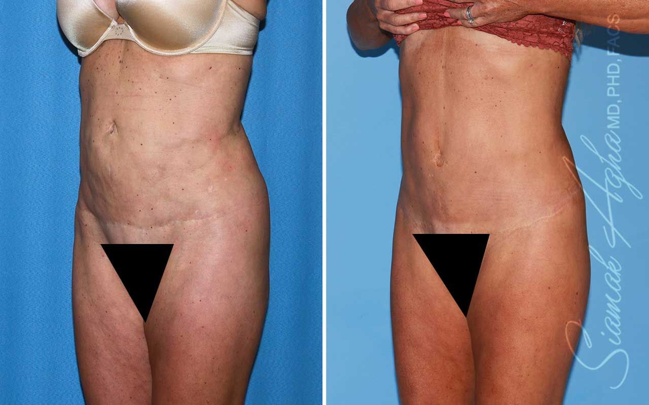 Lower Body Lift Before & After