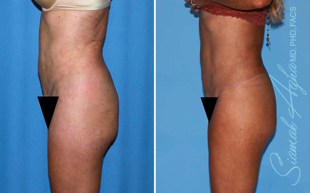 Lower Body Lift Before & After