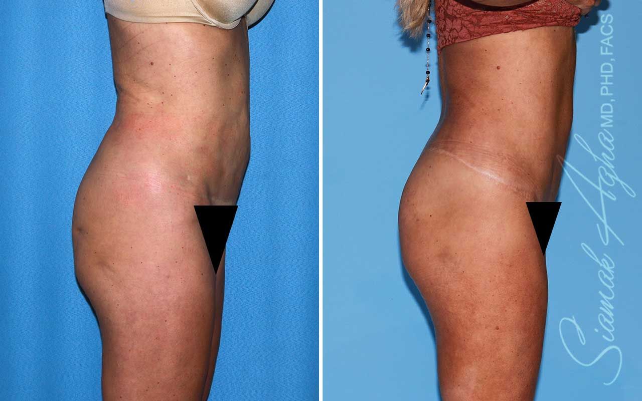 Lower Body Lift Before & After