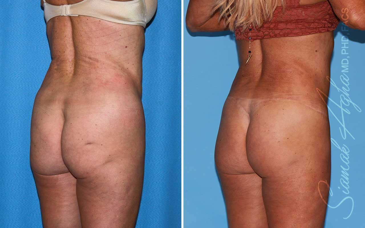 Lower Body Lift Before & After