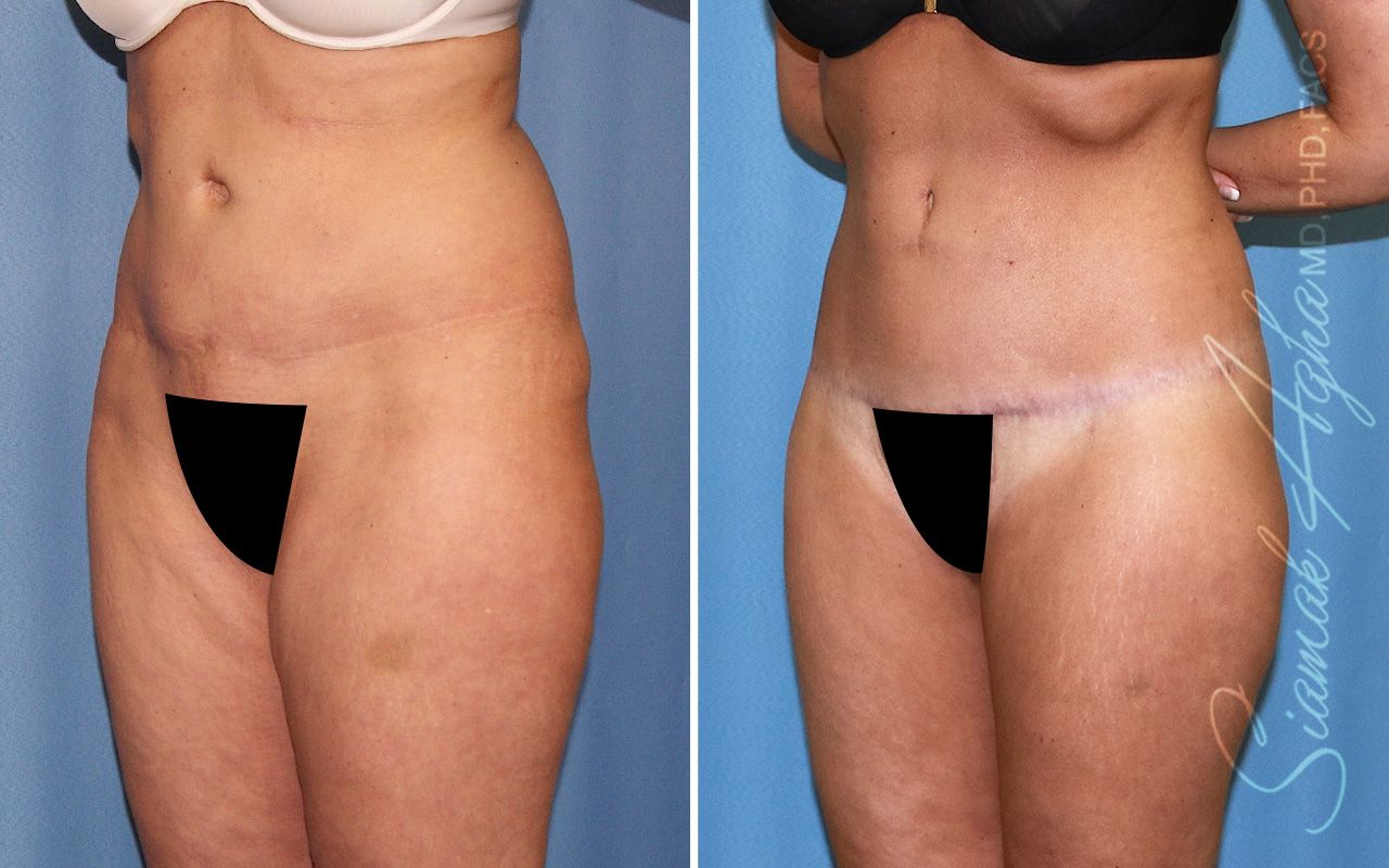 Lower Body Lift Before & After