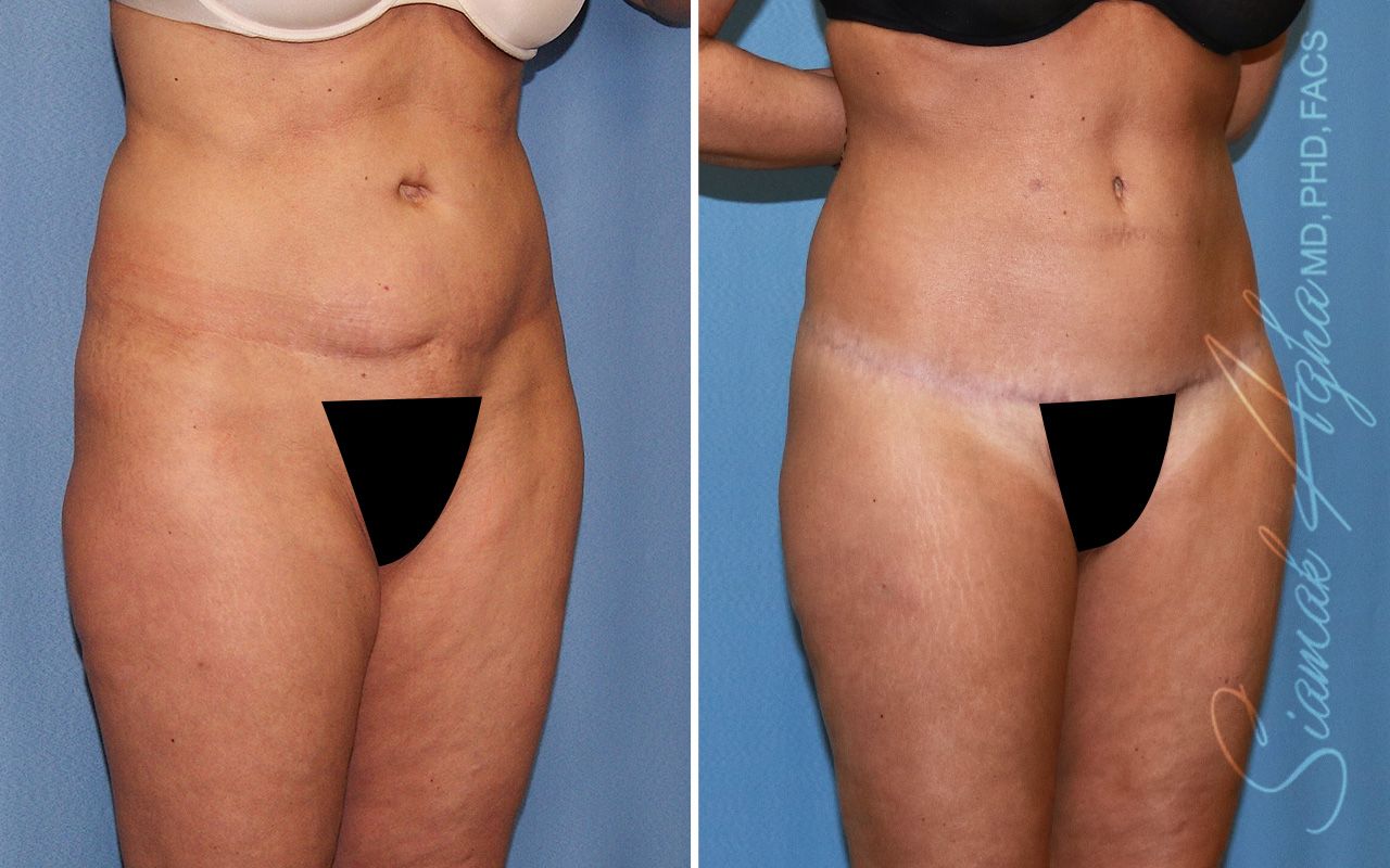 Lower Body Lift Before & After
