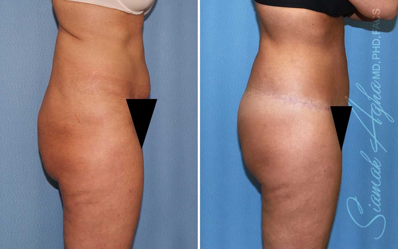 Lower Body Lift Before & After