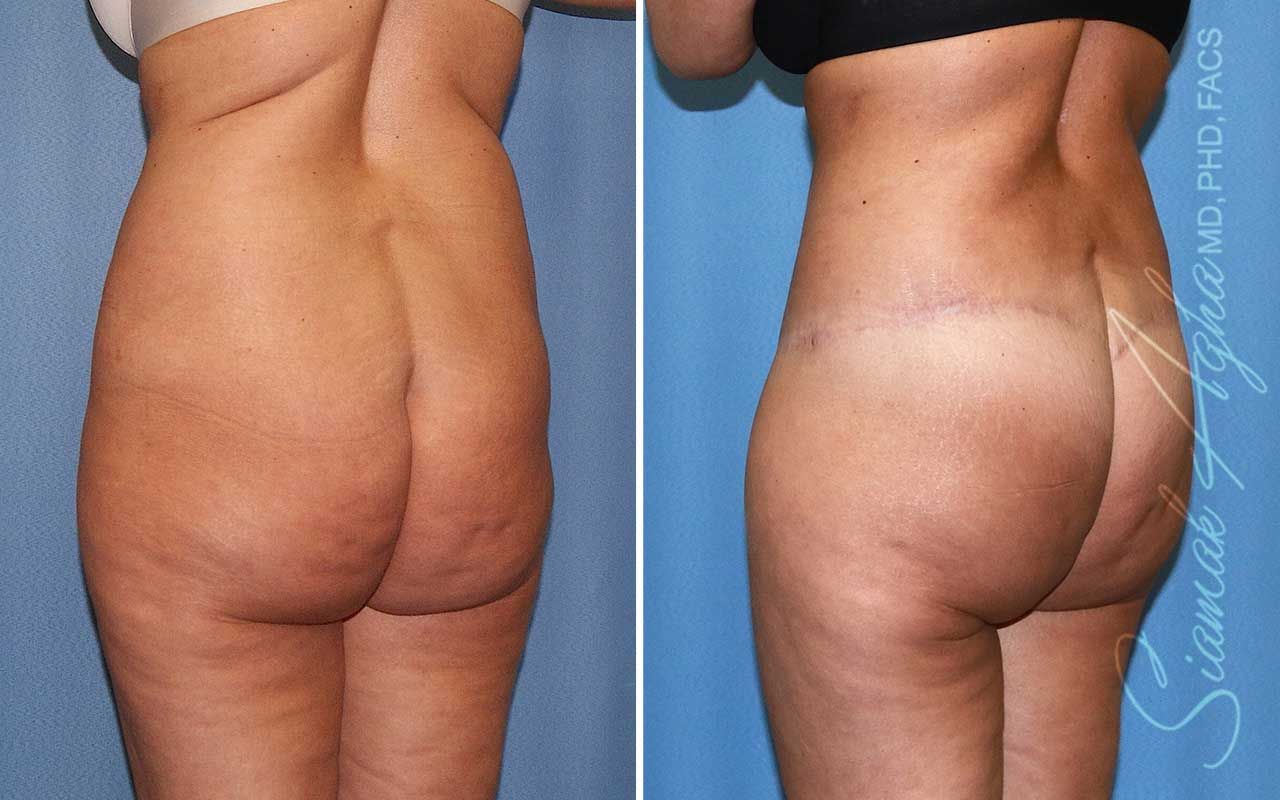 Lower Body Lift Before & After