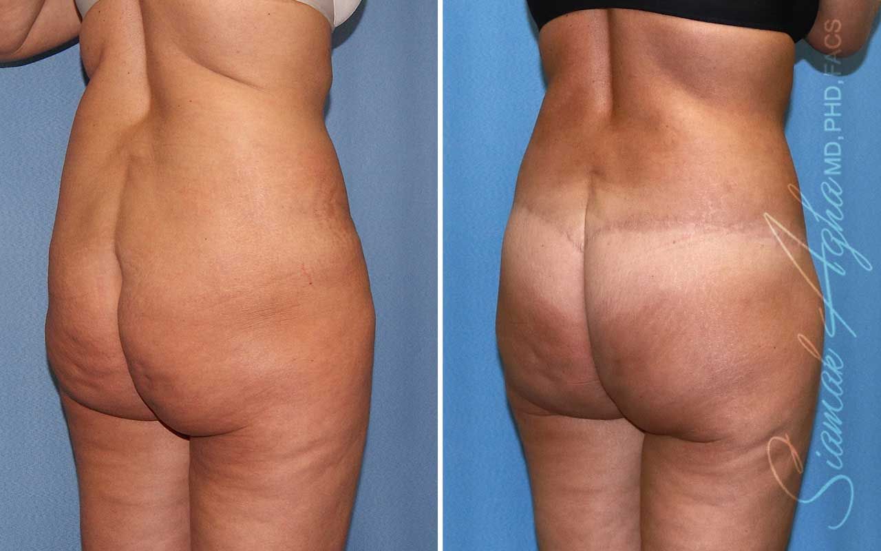 Lower Body Lift Before & After