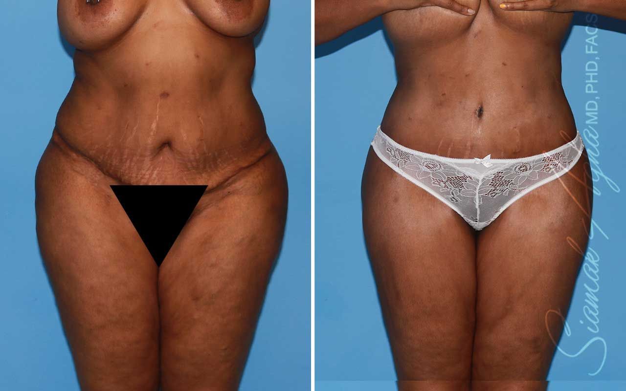 Lower Body Lift Before & After