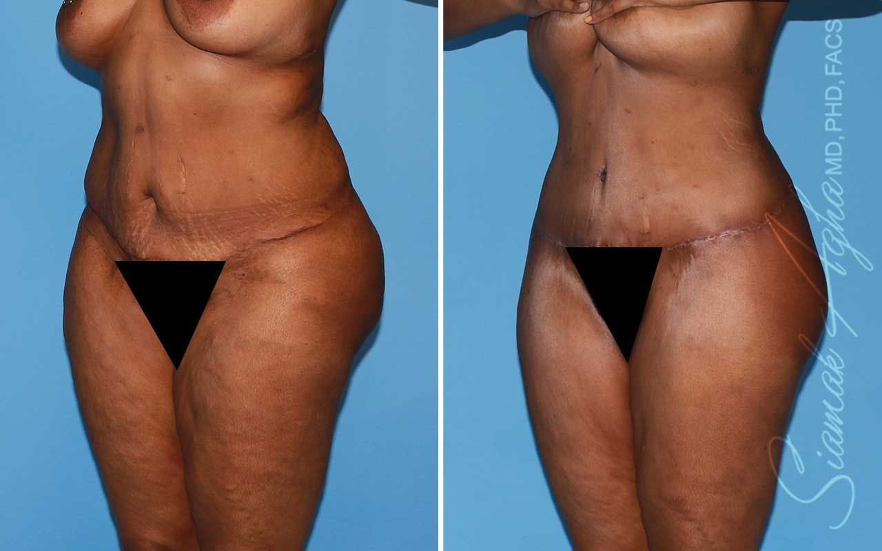 Lower Body Lift Before & After