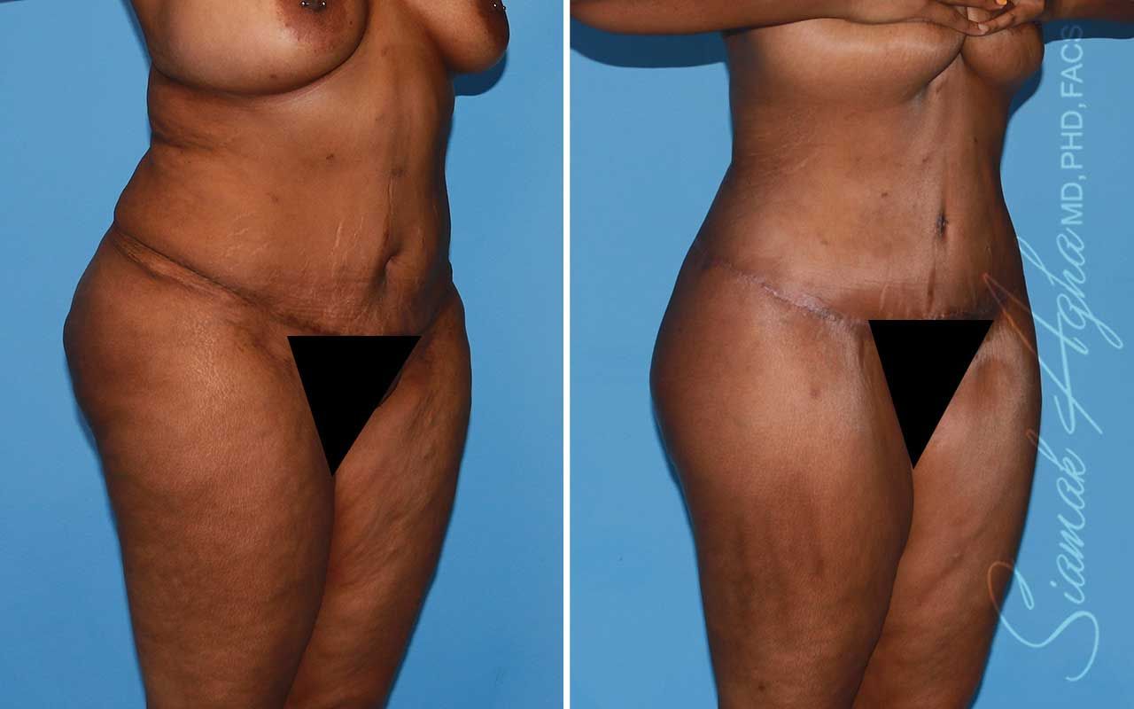 Lower Body Lift Before & After