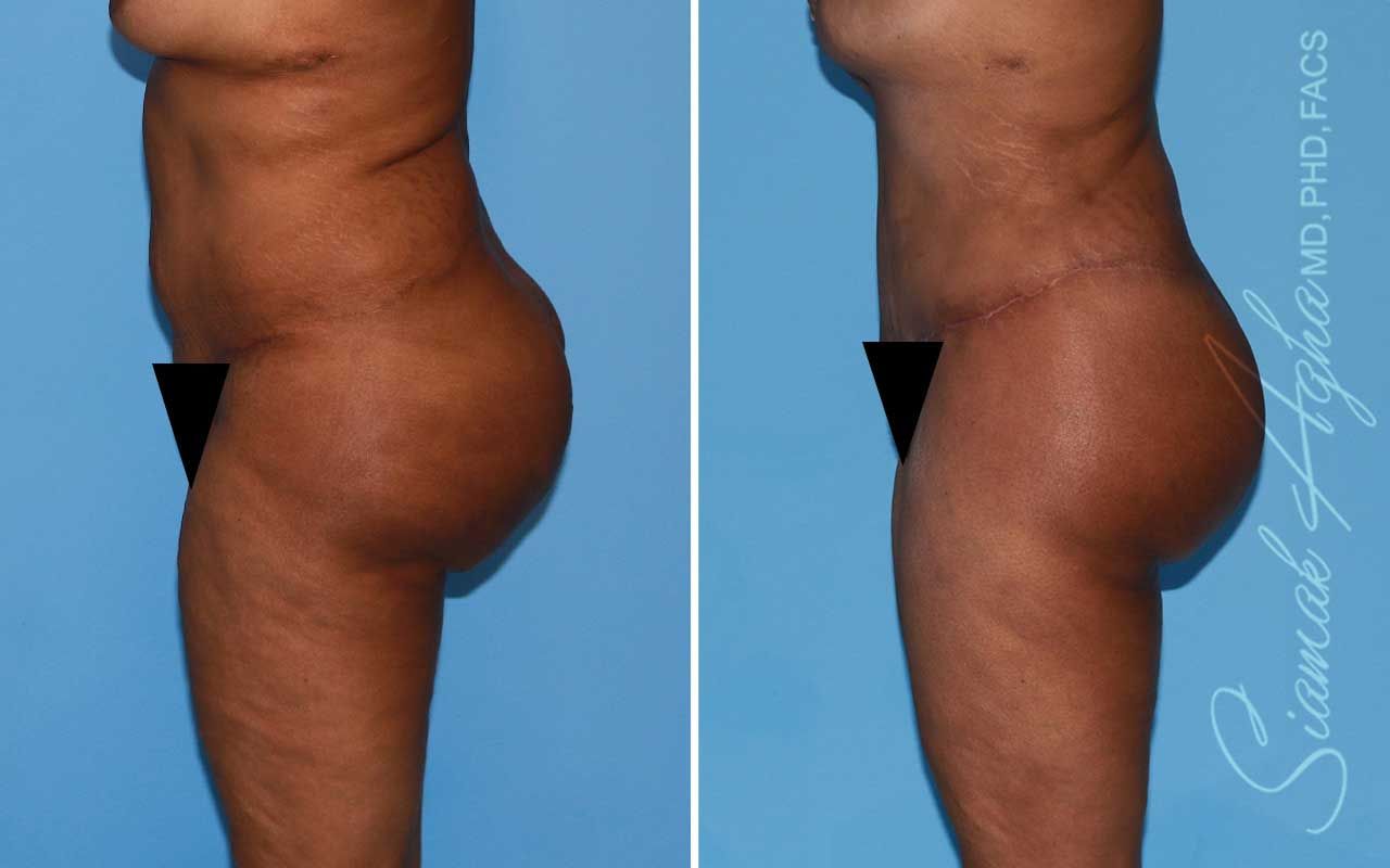 Lower Body Lift Before & After