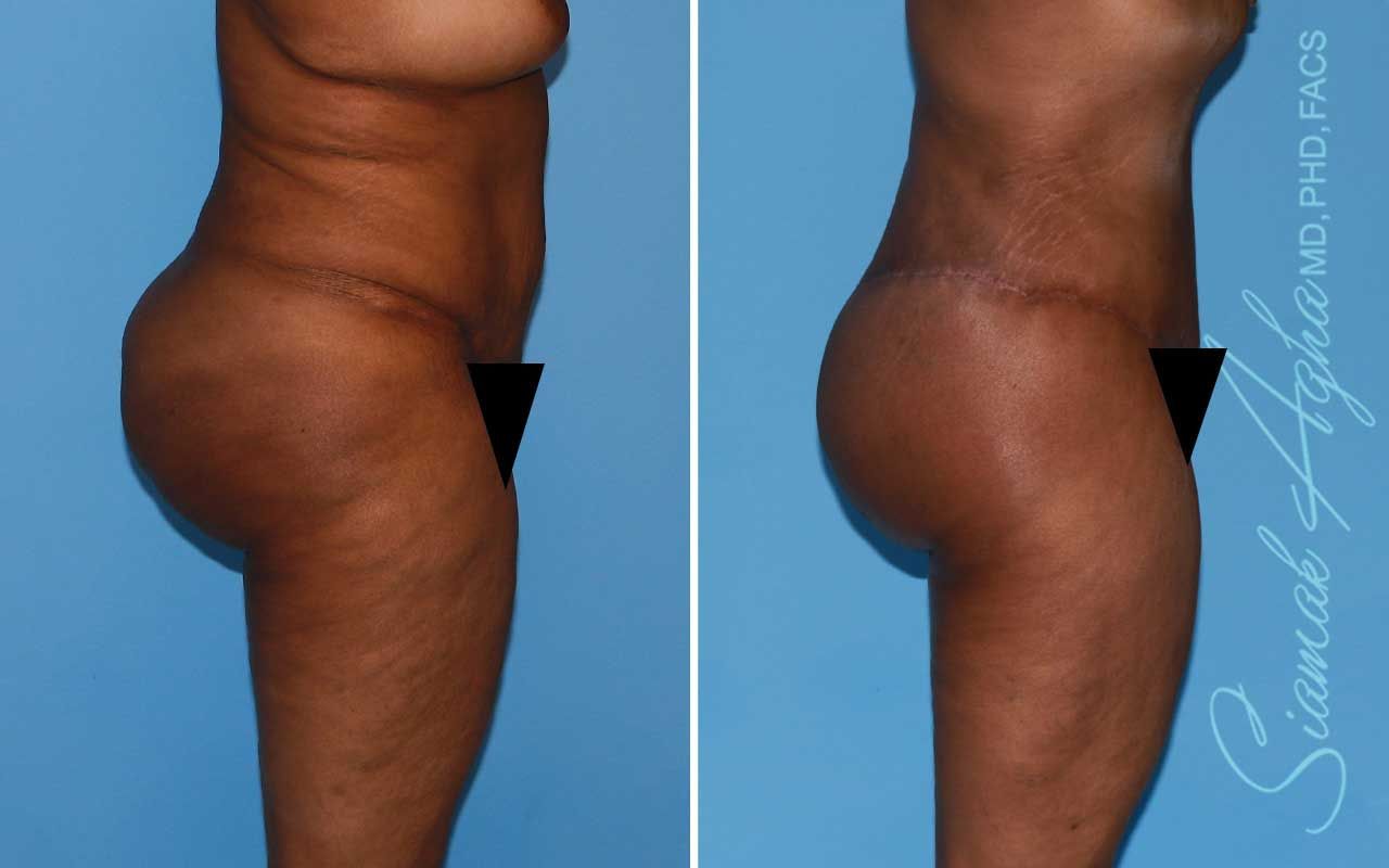 Lower Body Lift Before & After