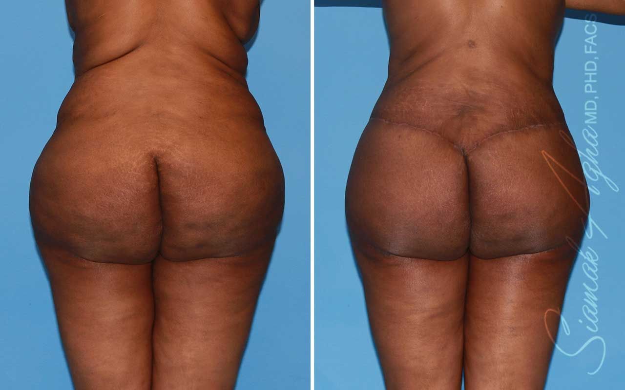 Lower Body Lift Before & After