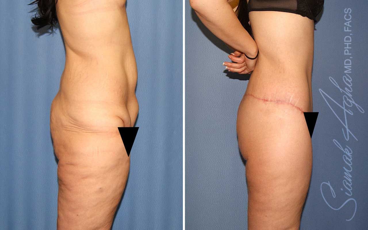 Lower Body Lift Before & After