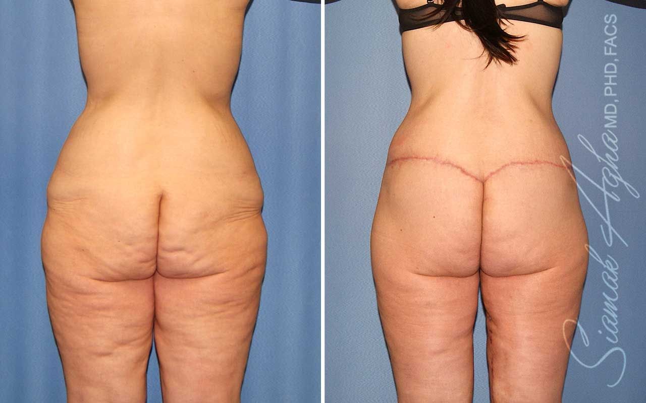 Lower Body Lift Before & After