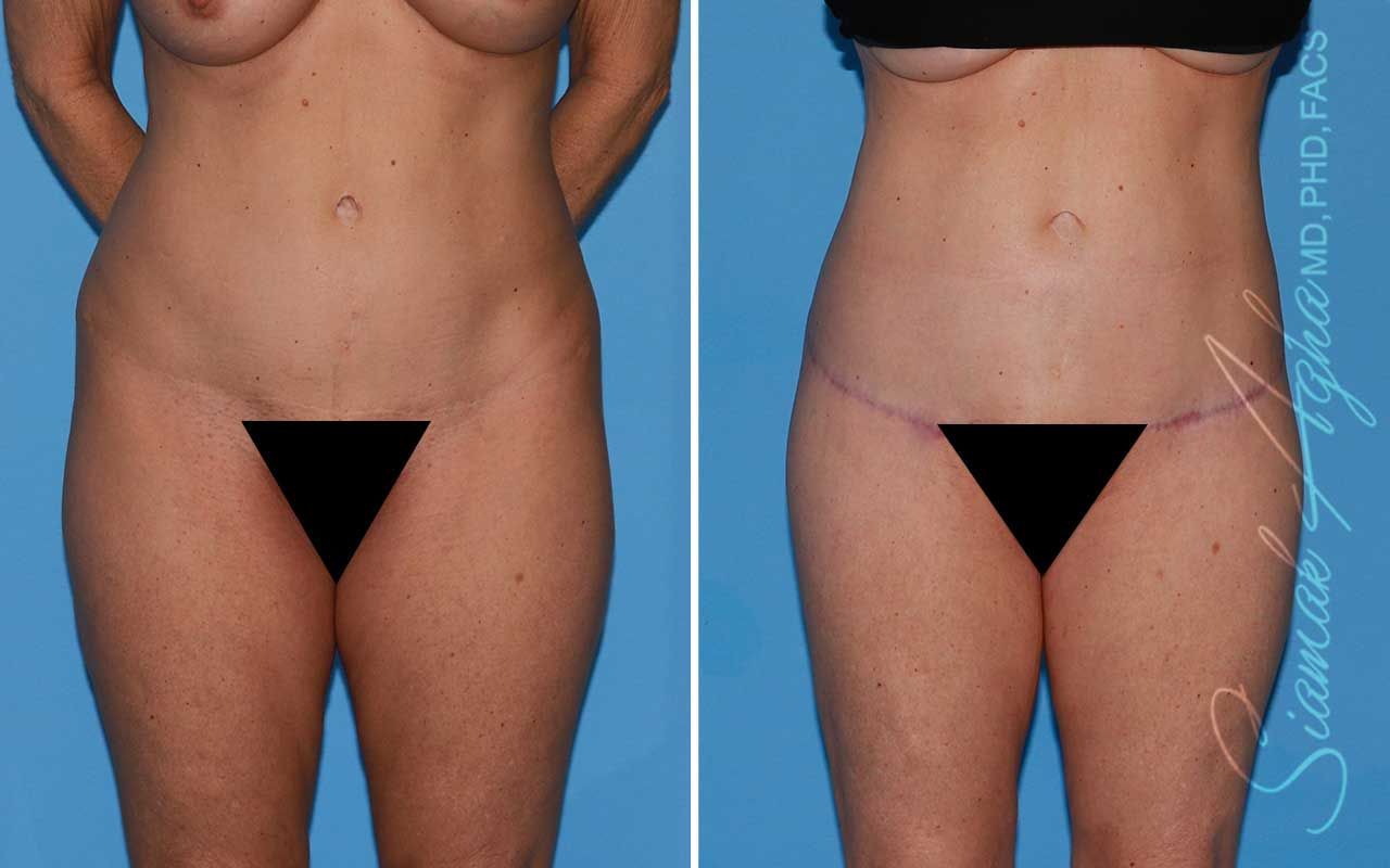 Lower Body Lift Before & After