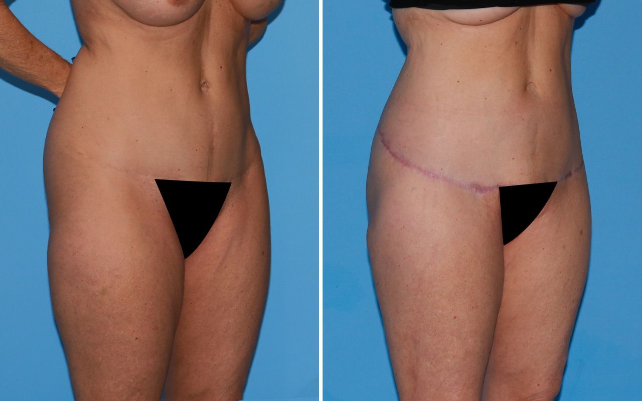 Lower Body Lift Before & After