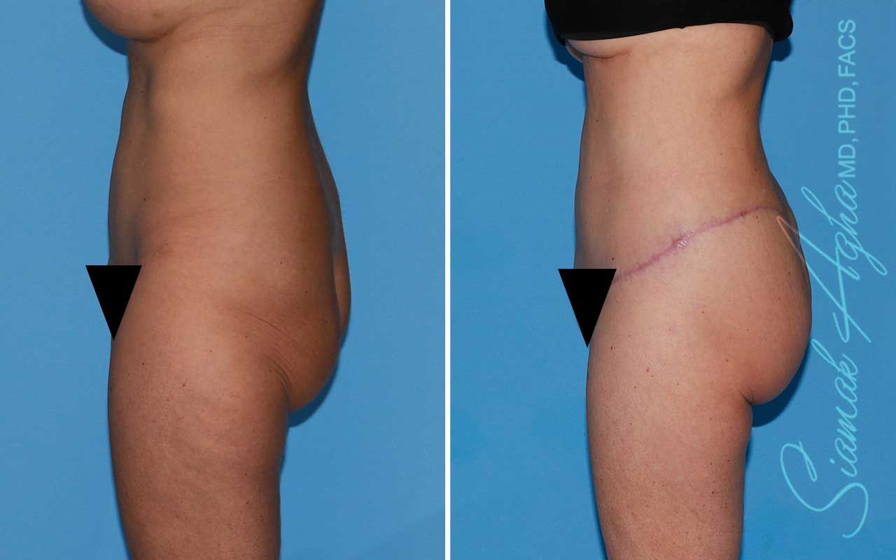 Lower Body Lift Before & After