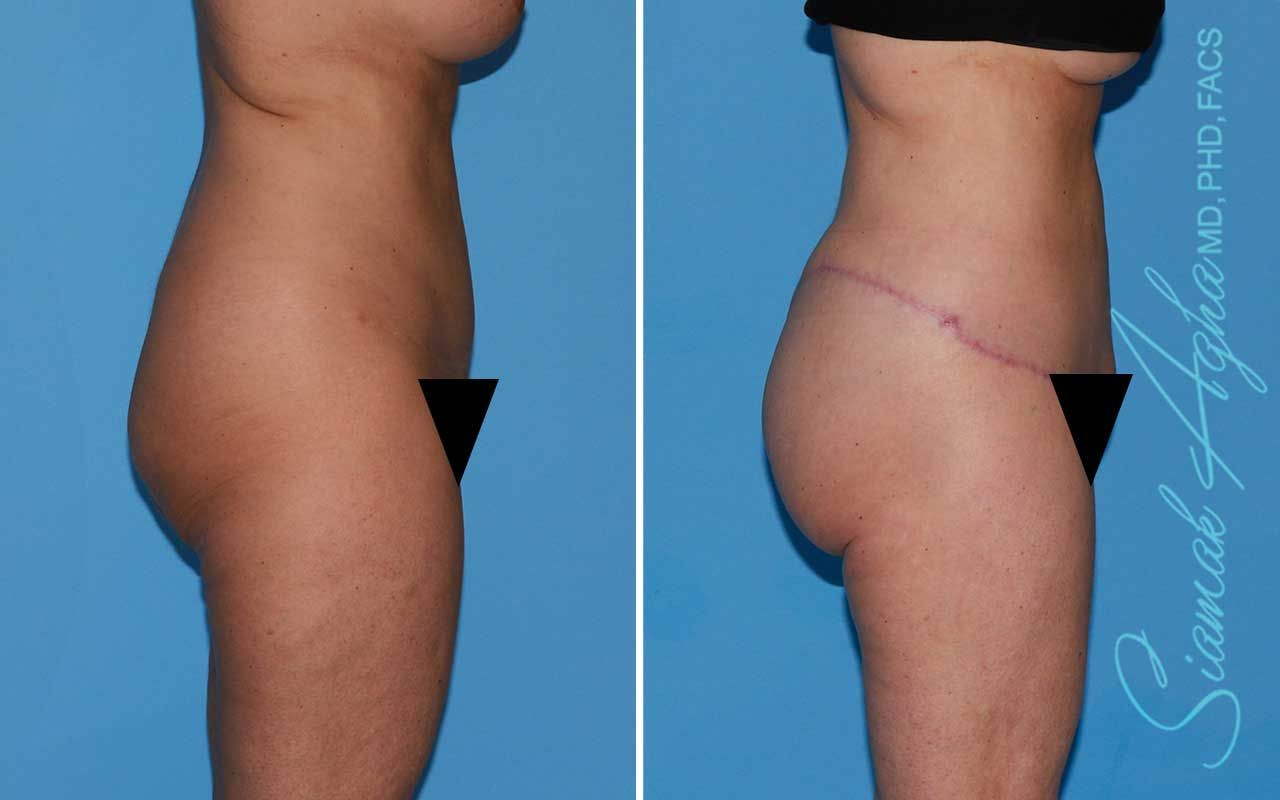 Lower Body Lift Before & After