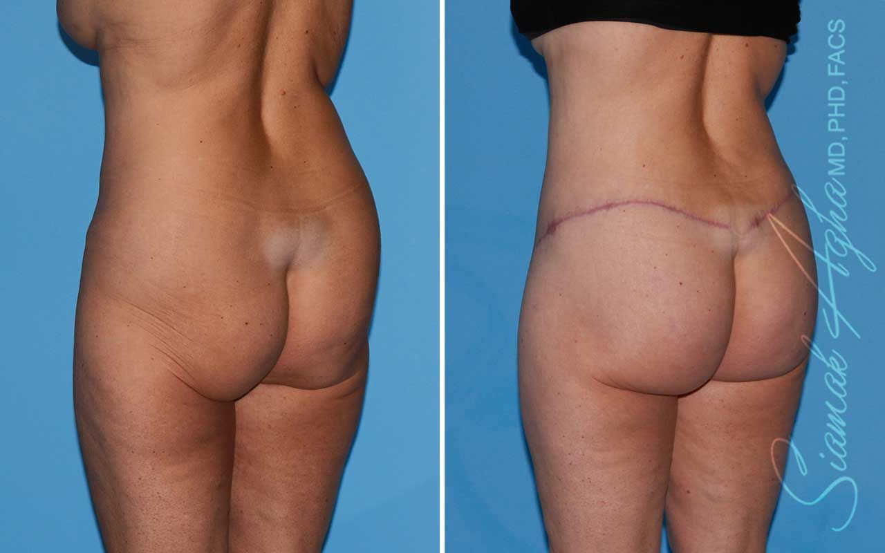 Lower Body Lift Before & After