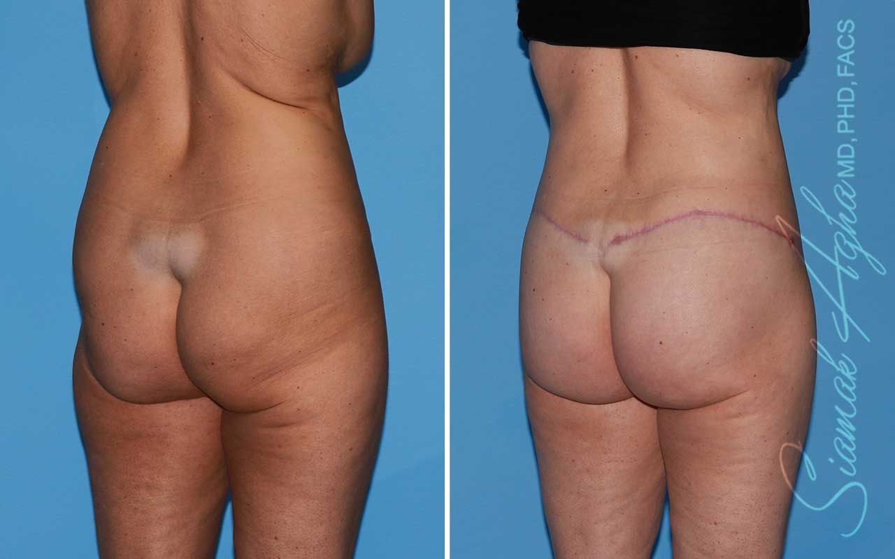 Lower Body Lift Before & After