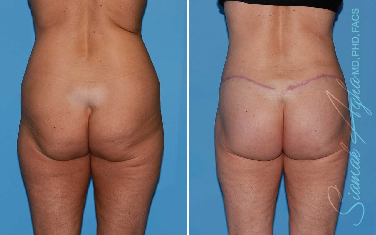Lower Body Lift Before & After