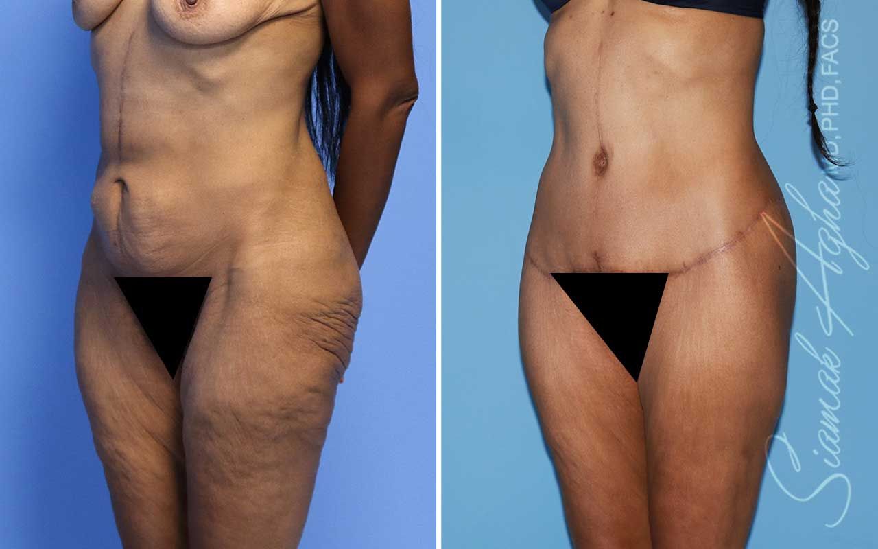 Lower Body Lift Before & After