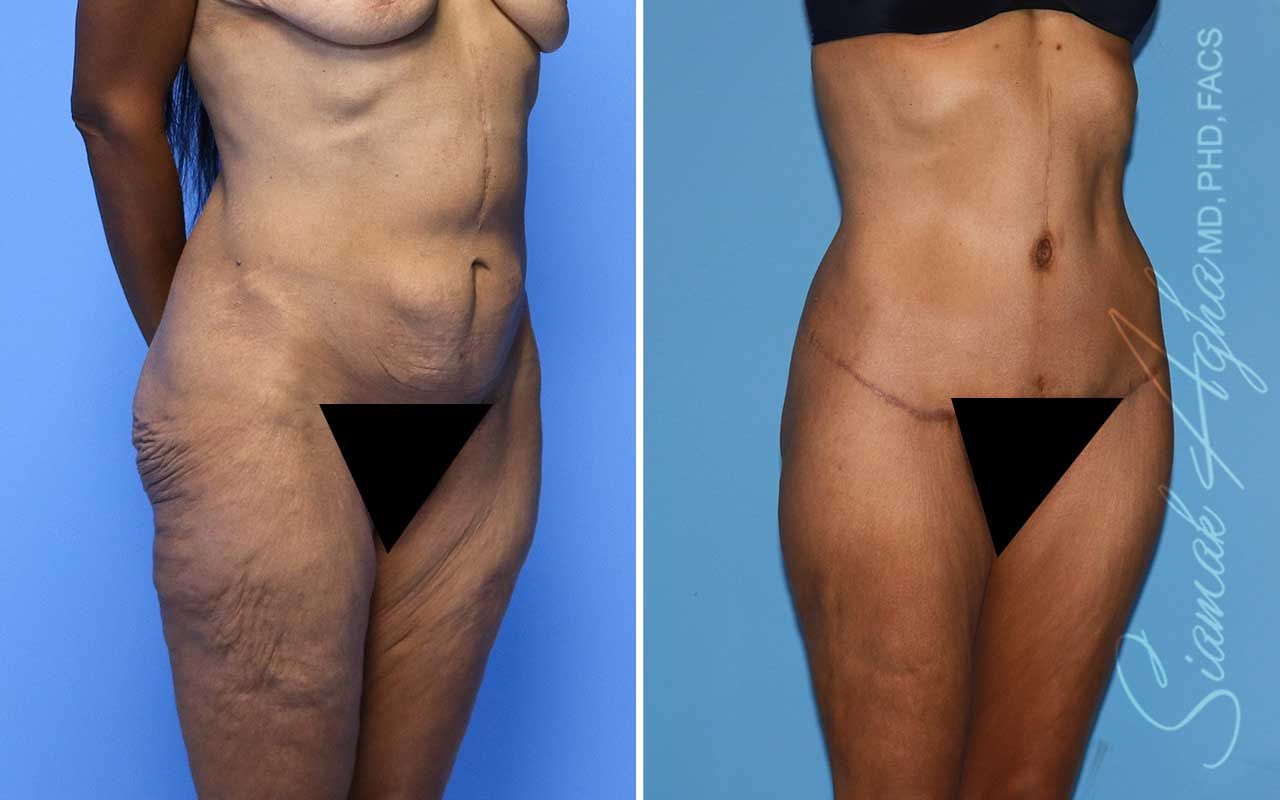 Lower Body Lift Before & After