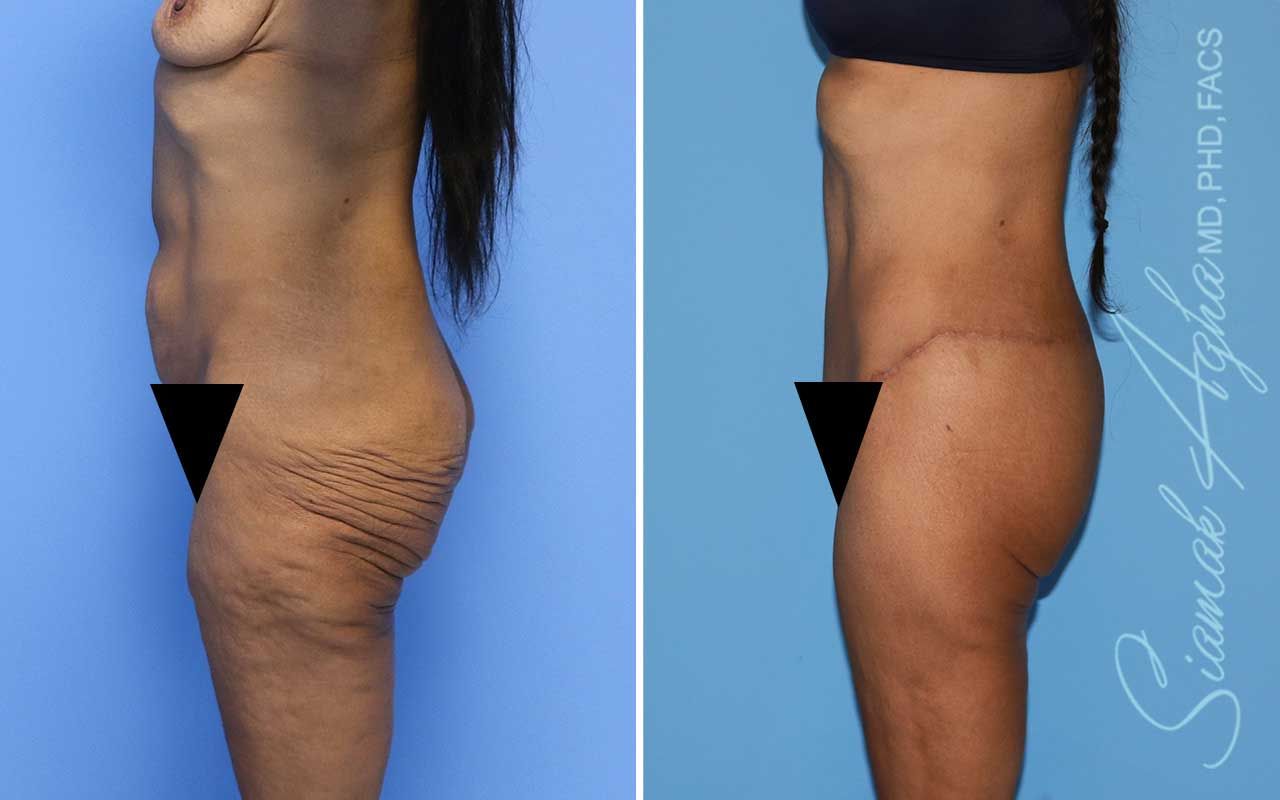 Lower Body Lift Before & After