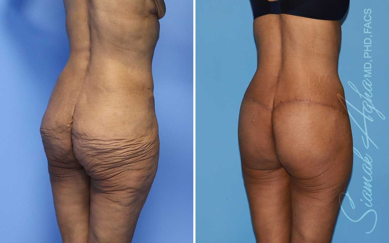 Lower Body Lift Before & After