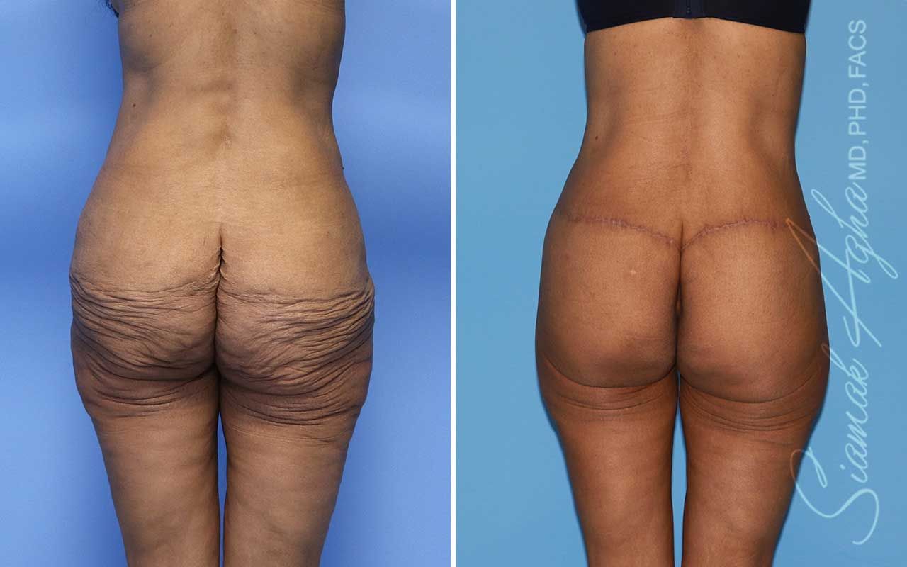 Lower Body Lift Before & After