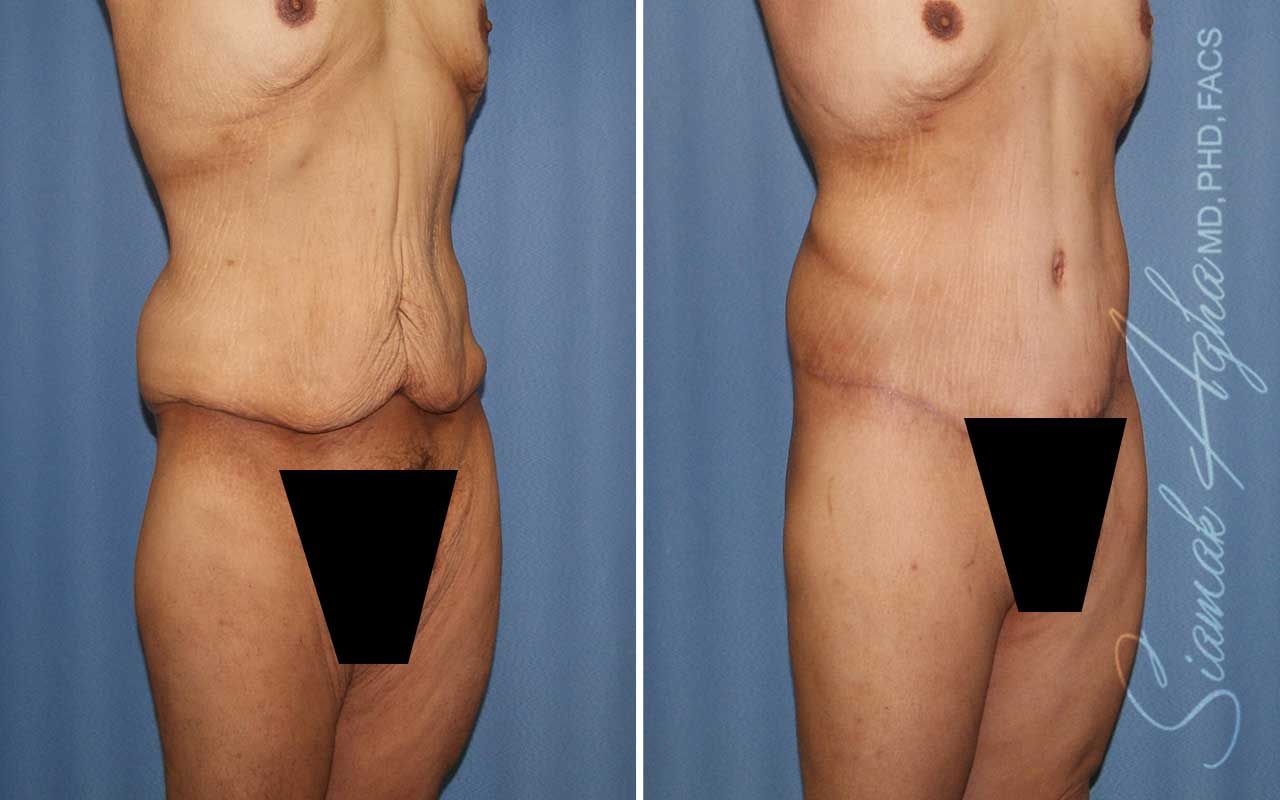 Lower Body Lift Before & After