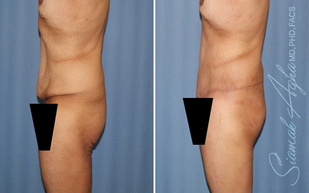 Lower Body Lift Before & After