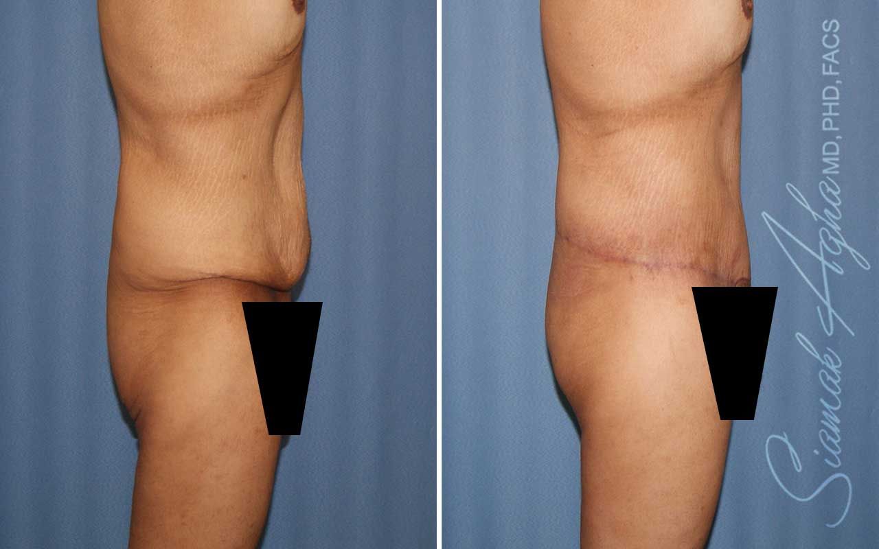 Lower Body Lift Before & After